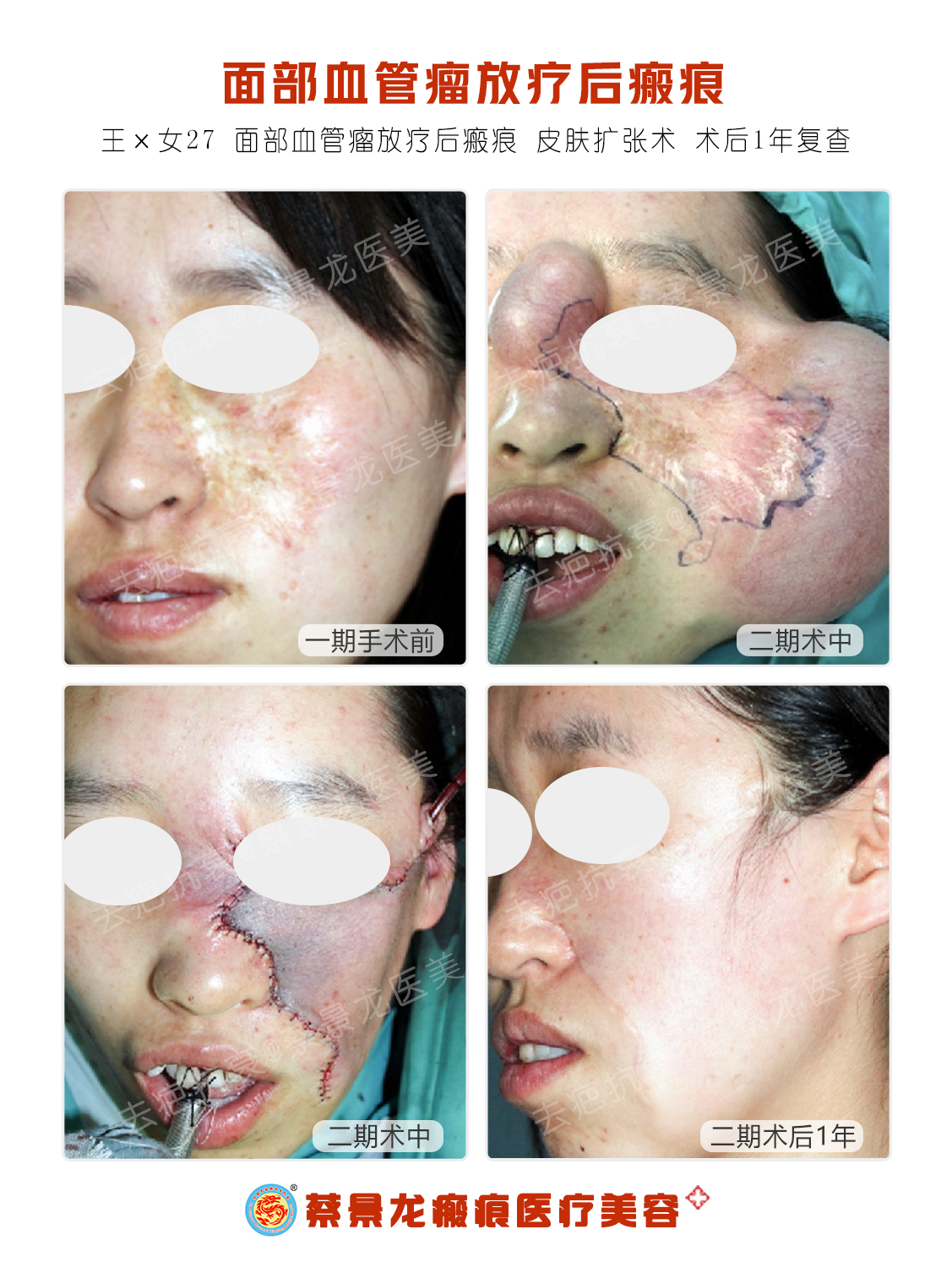 面部血管瘤同位素放疗后瘢痕皮肤扩张术治疗