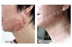 皮肤扩张术治疗后恢复更美观【痤疮下颌瘢痕疙瘩】