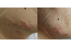 双下颌疤痕疙瘩非手术治疗10个月效果反馈