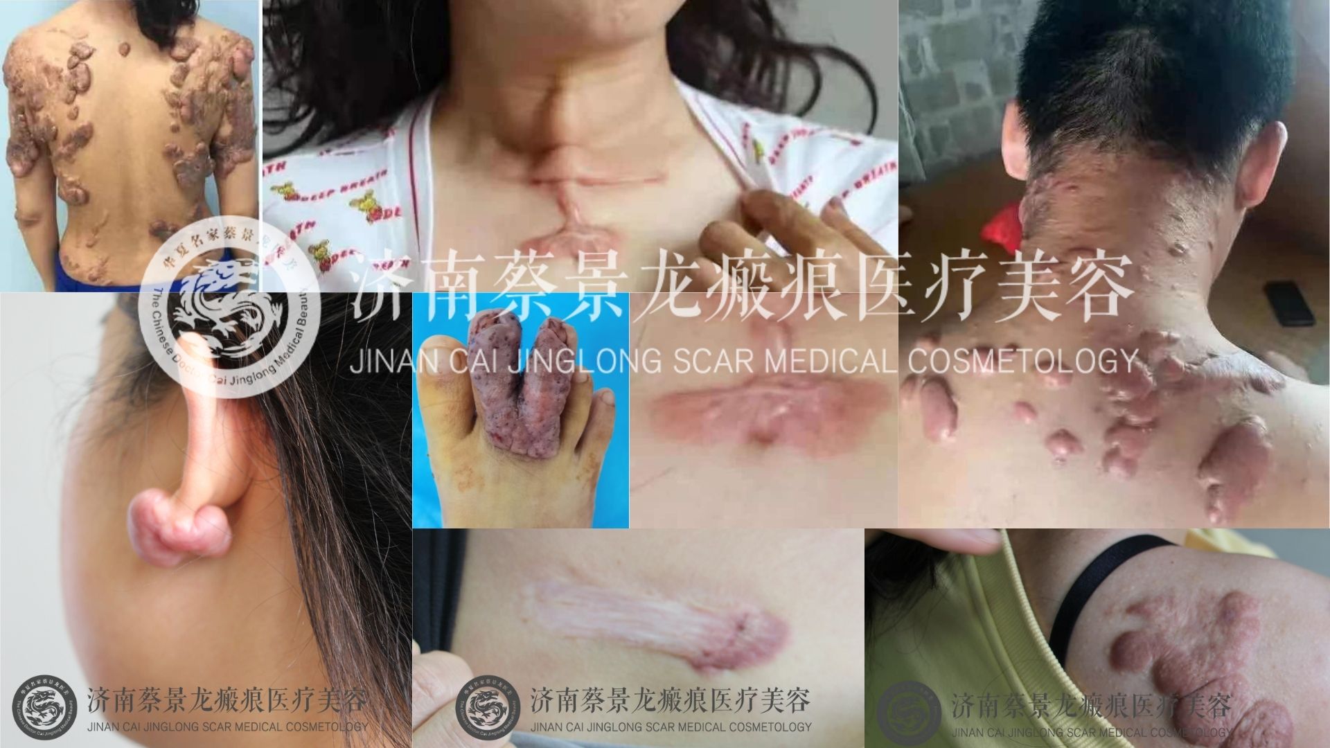 【蔡教授疤痕科普】为什么疤痕被称为“国际难题“ ”“不死癌症”？夏季应该如何防治疤痕？