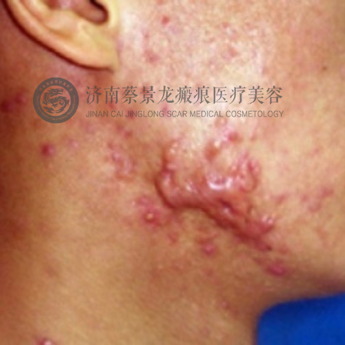 【蔡教授瘢痕科普】警惕！“小痘痘”摇身一变成「巨大瘢痕疙瘩」，治疗宜早不宜迟！