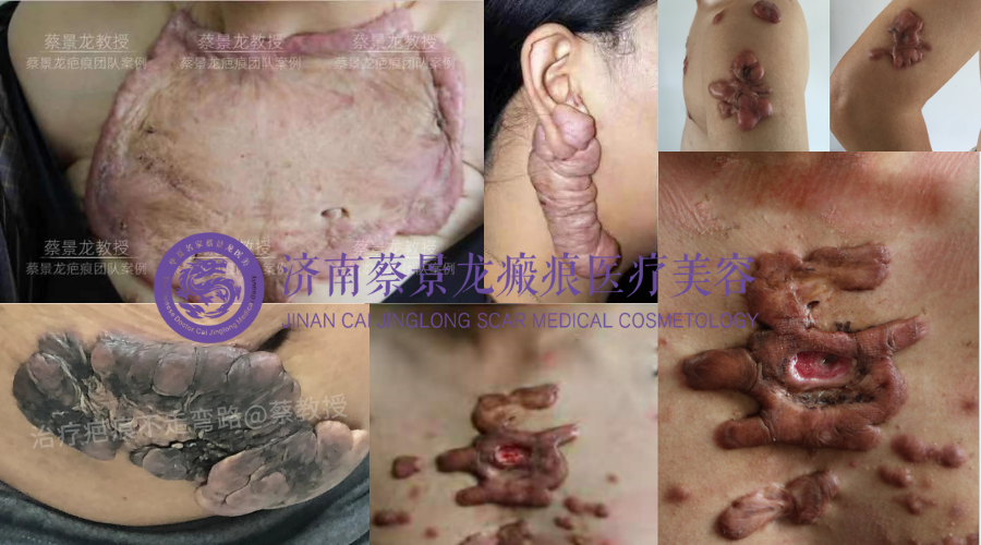 【蔡教授瘢痕治疗科普】大面积疤痕疙瘩能一次性修复吗？如何治疗？能治愈吗？