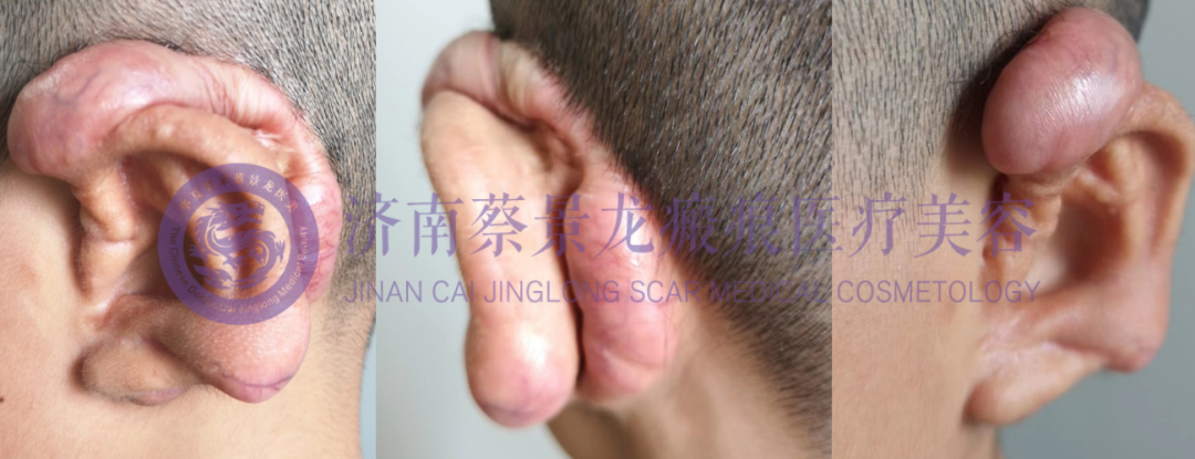 【蔡教授治疗病例分享】“瘢痕治疗的蔡景龙模式”彻底治愈左耳再造术后瘢痕疙瘩一例，2年后快递锦旗表示感谢