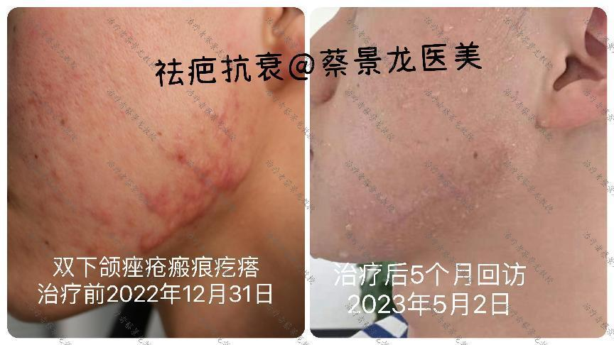 [蔡景龙治疤案例1002]因疤痕疙瘩手术后复发率较高，就不能用手术治疗了吗？