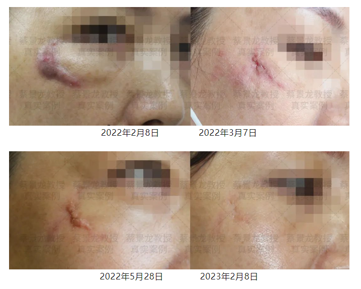 [蔡景龙治疤案例1022]38岁董女士面部外伤瘢痕一年后恢复效果