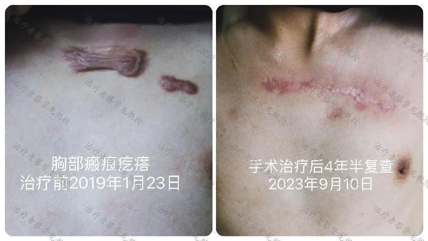 [蔡景龙治疤案例1023]34岁宋先生胸部痤疮瘢痕疙瘩治疗后4年半情况 