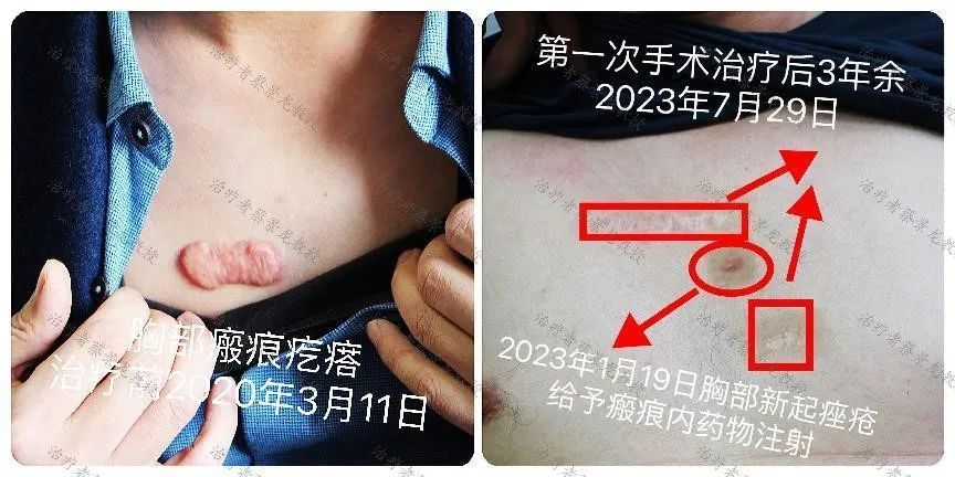 [蔡景龙治疤案例1024]35岁王先生胸部瘢痕治疗后3年多的恢复效果好，又来治疗新发瘢痕