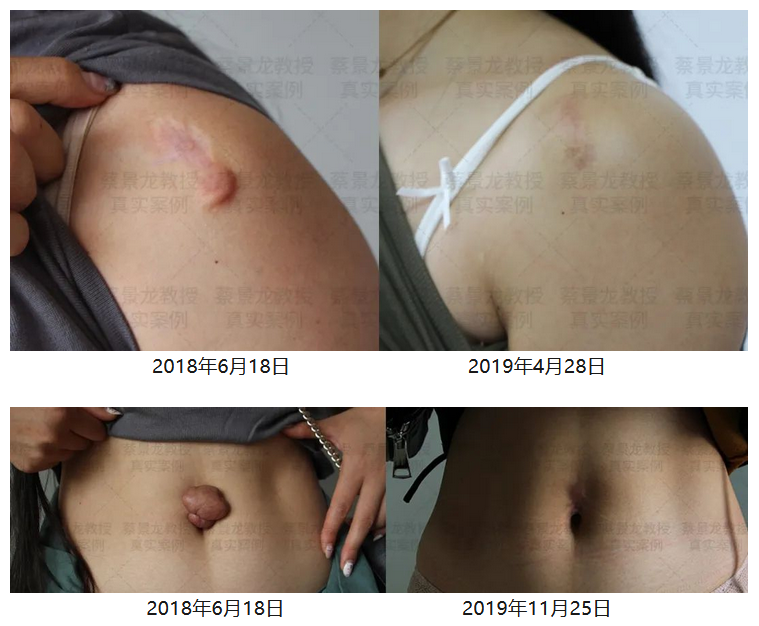 [蔡景龙治疤案例1025]32岁的邓女士打脐钉后引起脐部大疙瘩瘢痕治疗一年半的效果 