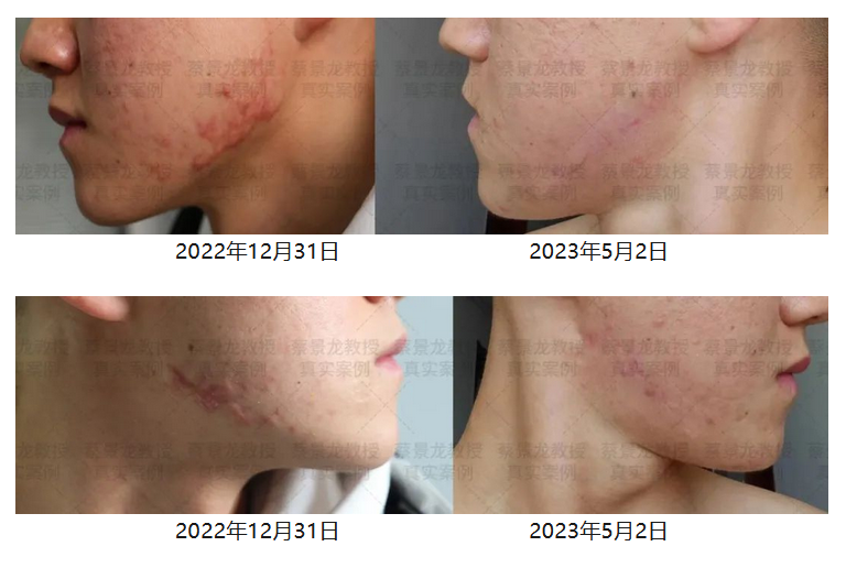 [蔡景龙治疤案例1027]23岁刘先生下颌痤疮引发瘢痕疙瘩治疗修复半年效果 