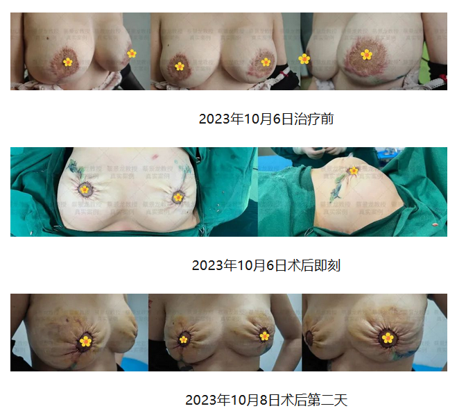 [蔡景龙治疤案例1028]34岁卓女士治疗疤痕的同时行乳晕乳房塑型，既去除了瘢痕，又美化了乳房，一箭双雕 