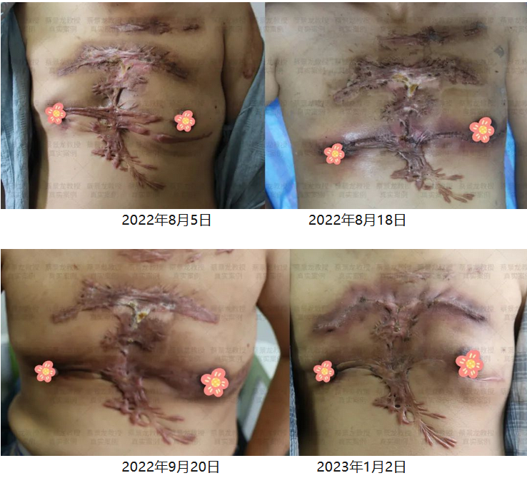 [蔡景龙治疤案例1029]52岁董女士胸部痤疮瘢痕疙瘩1年3个月的恢复效果 