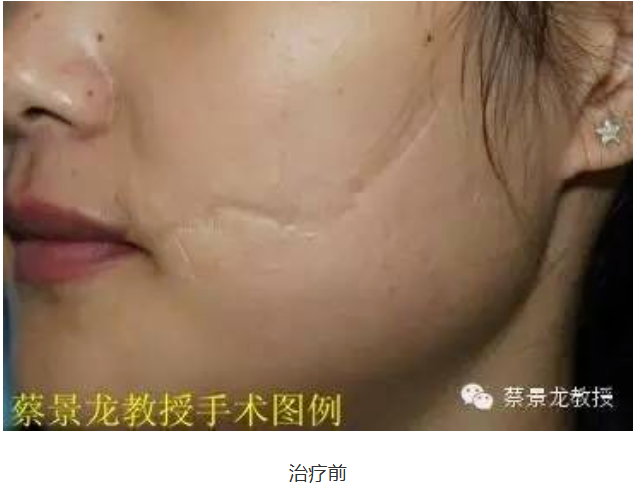 [蔡景龙治疤案例1030]面部凹陷性伤疤切除改形+点阵激光治疗效果分享 