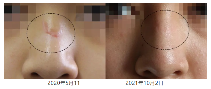 [蔡景龙治疤案例1034]13岁小朋友鼻背部瘢痕恢复后1年半的效果
