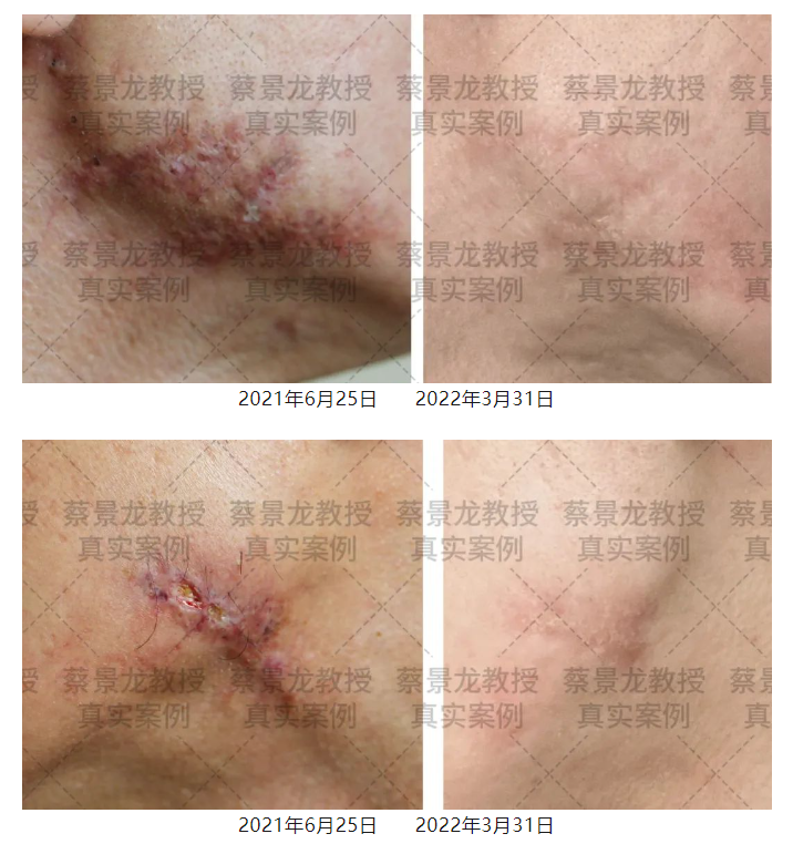 [蔡景龙治疤案例1041]双下颌瘢痕疙瘩激光治疗后效果不佳采用蔡景龙模式治疗后8个月恢复效果分享