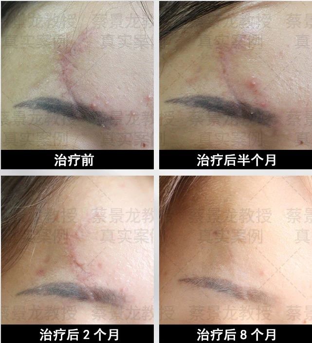 [蔡景龙治疤案例1059]右额部外伤后瘢痕，经蔡景龙模式早期治疗后8个月的情况